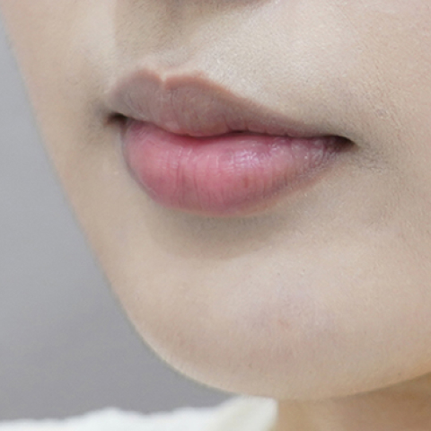 Trước khi tiêm filler môi (Kiểu môi cuộn vào trong)