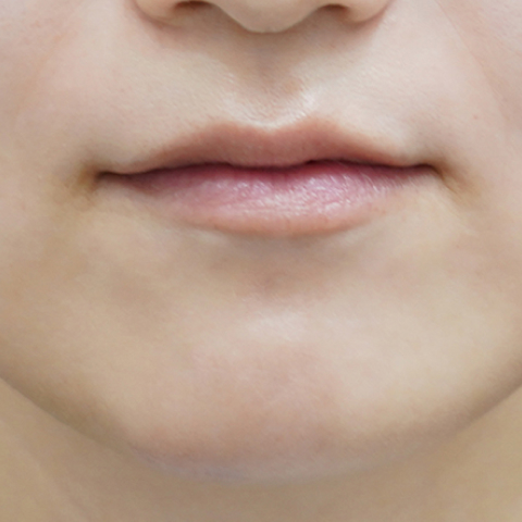 Trước khi tiêm filler môi (Kiểu môi có nhân trung dài)