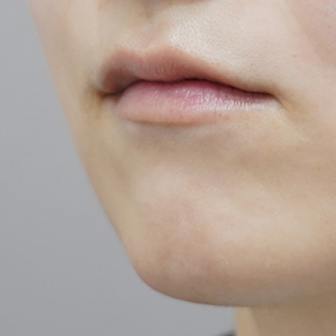 Trước khi tiêm filler môi (Kiểu môi có nhân trung dài)