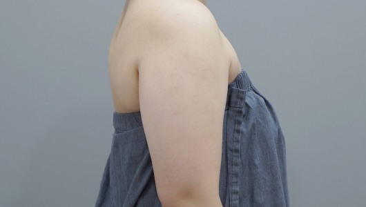 Hình ảnh trước điều trị ONDA Lifting vùng cơ thể 2