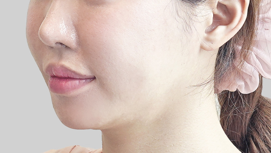 Hình ảnh trước điều trị ONDA Lifting vùng khuôn mặt 3