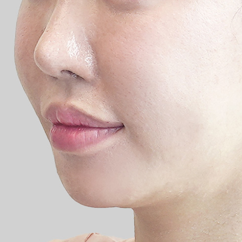 Hình ảnh trước điều trị ONDA Lifting vùng khuôn mặt trên di động 3