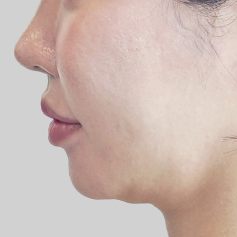 Hình ảnh trước điều trị ONDA Lifting vùng khuôn mặt trên di động 4