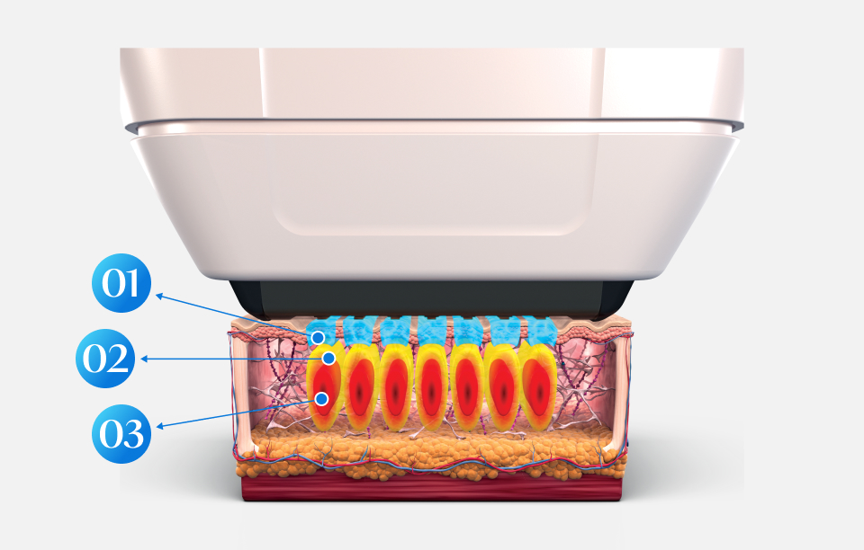 Hình minh họa công nghệ SUPERB của Sofwave phiên bản di động