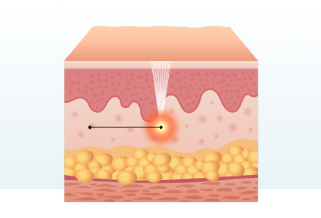 Hình minh họa đặc điểm điều trị Sofwave