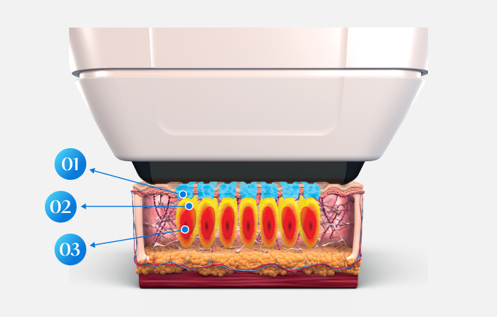 Hình minh họa công nghệ SUPERB của Sofwave
