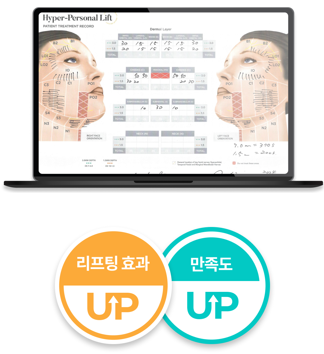 Hình ảnh minh họa trên di động về Ultherapy Prime không lo hóp má
