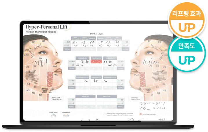 Hình ảnh minh họa thiết kế điều trị Ultherapy Prime không lo hóp má